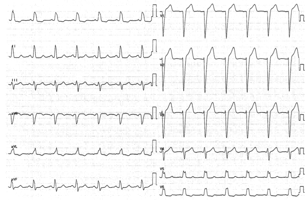 左脚ブロック（LBBB）：病態生理、臨床的意義 | ウェルビーイングクリニック駒沢公園