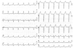 左脚ブロック（LBBB）：病態生理、臨床的意義 | ウェルビーイングクリニック駒沢公園