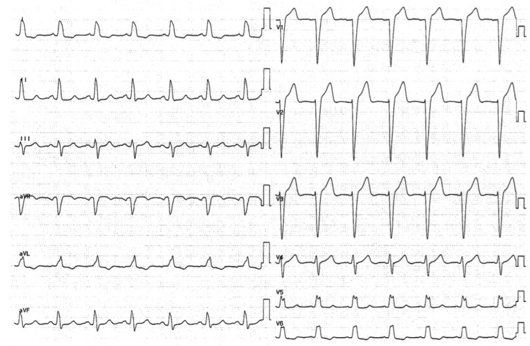左脚ブロック（LBBB）：病態生理、臨床的意義 | ウェルビーイングクリニック駒沢公園